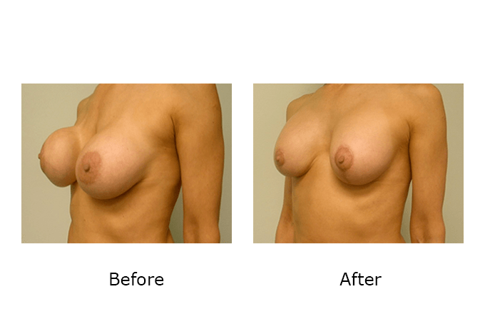 Breast Revision Case 9 - Before and After