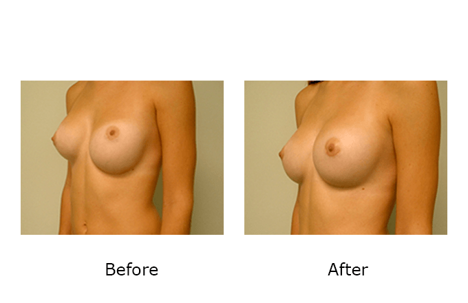Breast Revision Case 2 - Before and After