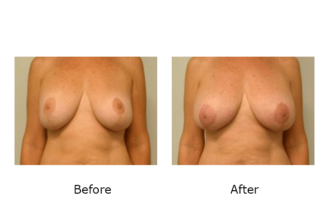 Breast Revision Case 4 - Before and After