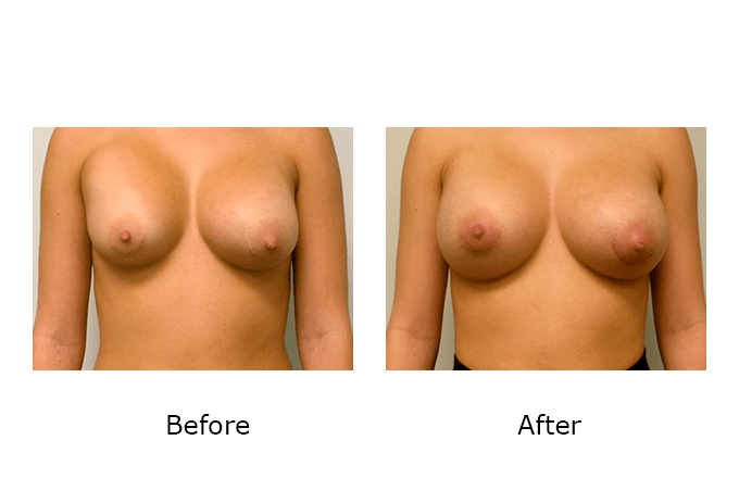 Breast Revision Case 5 - Before and After