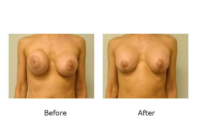 Breast Revision Case 8 - Before and After