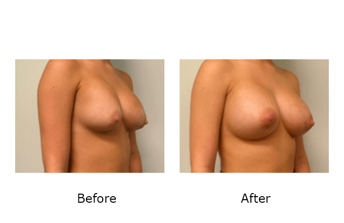 Breast Revision Case 7 - Before and After