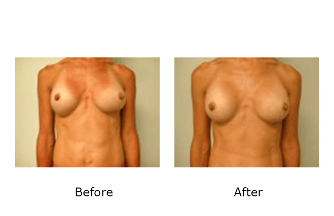 Breast Revision Case 3 - Before and After