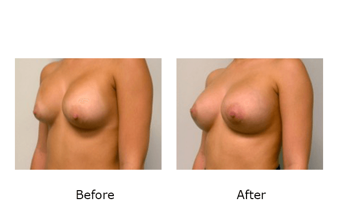 Breast Revision Case 6 - Before and After