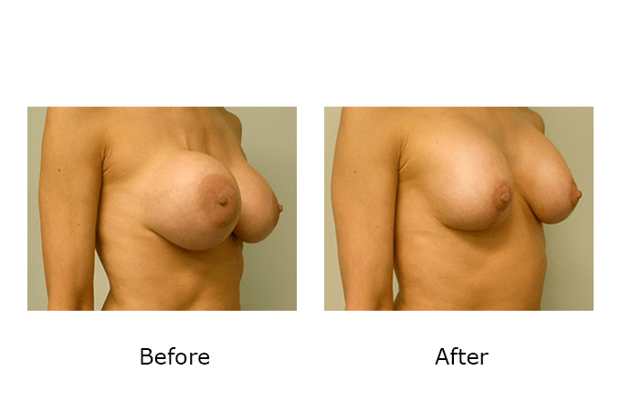 Breast Revision Case 10 - Before and After