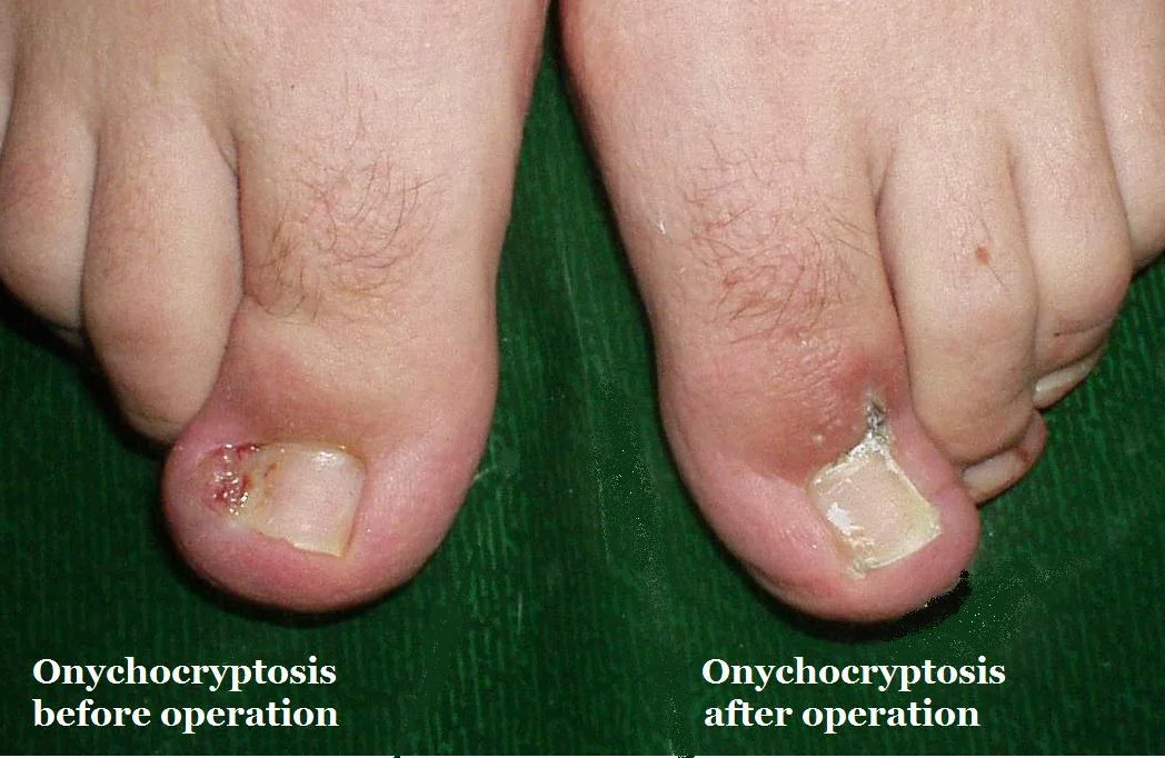WedgeResection