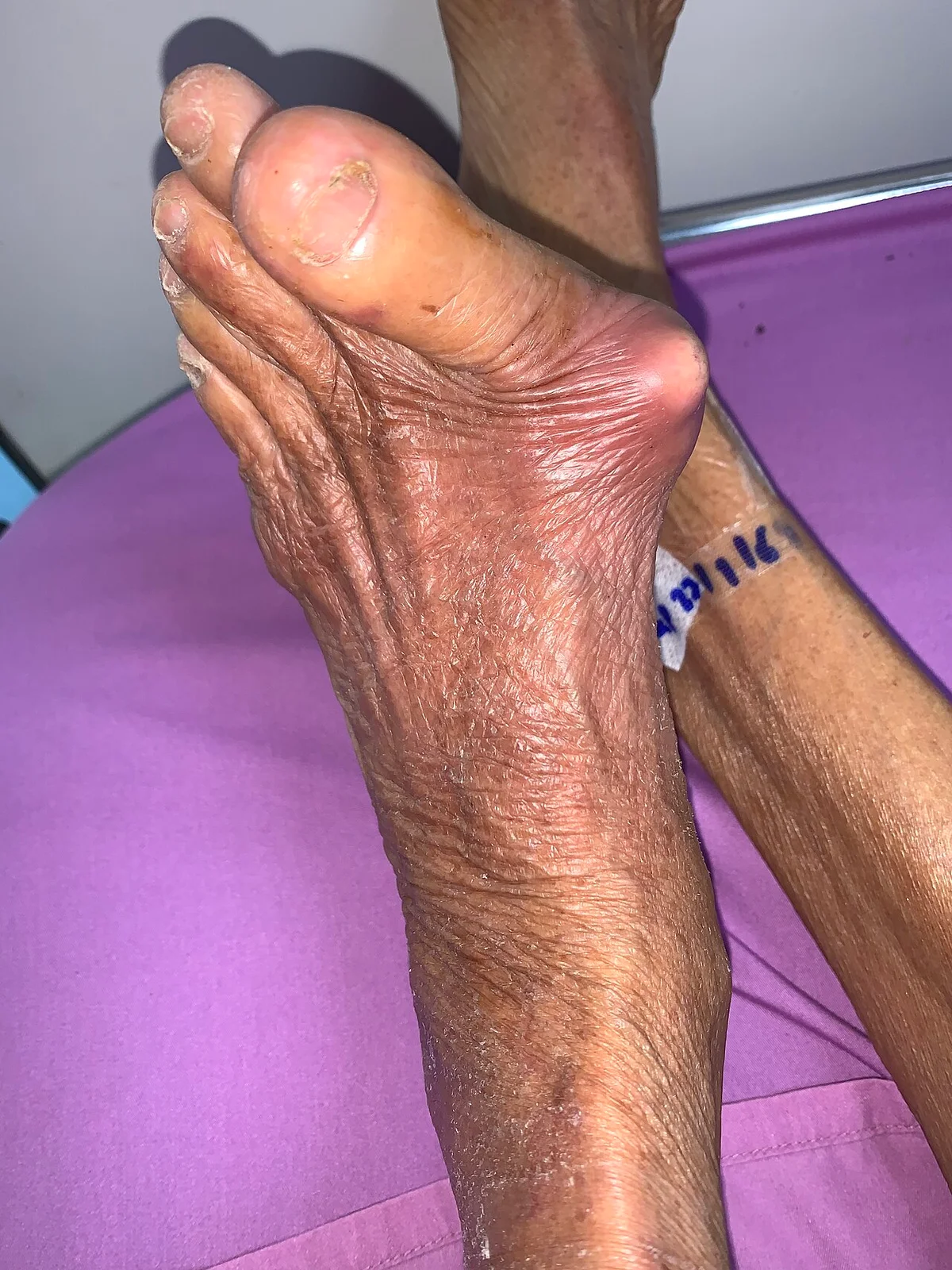 GoutGerald